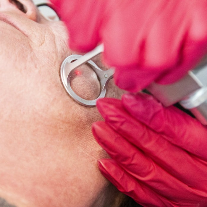 Alma Harmony TM Terapia laserowa