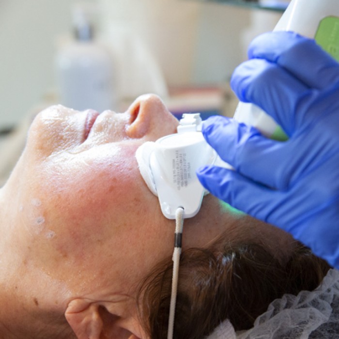Alma Harmony TM Terapia laserowa