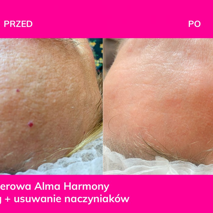 Radiofrekwencja mikroigłowa
