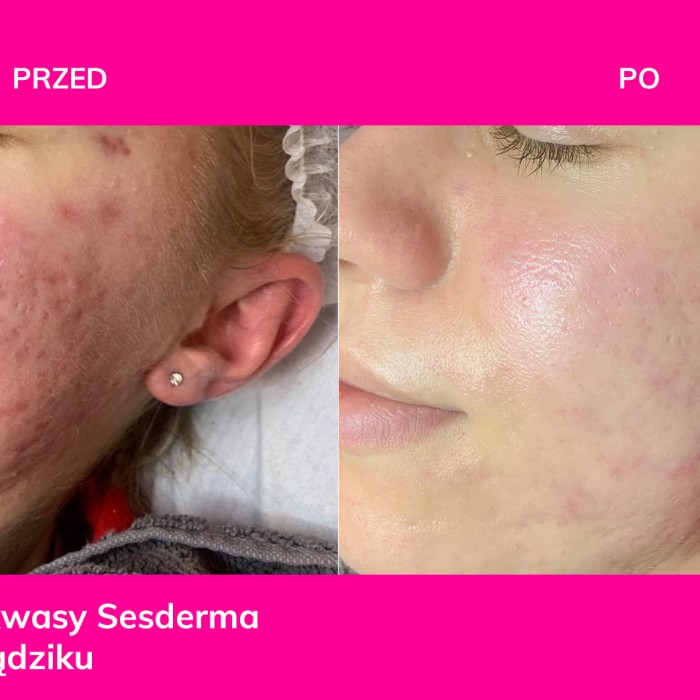 Alma Harmony TM Terapia laserowa