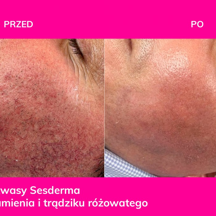KOBIDO - japońska liftingująca terapia manualna twarzy