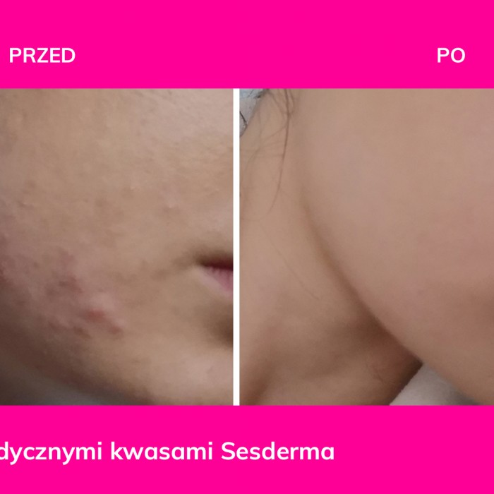 Mezoterapia mikroigłowa
